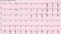 Ventricular pacemaker with acute inferior infarction