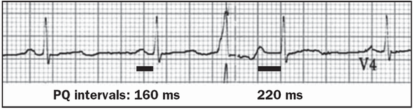 Puzzle 2007 1 33 Answer - ECGpedia