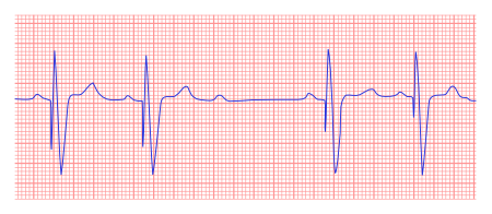 Pacemaker - ECGpedia