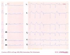 De Voogt ECG Archive - Intraventricular Conduction - ECGpedia