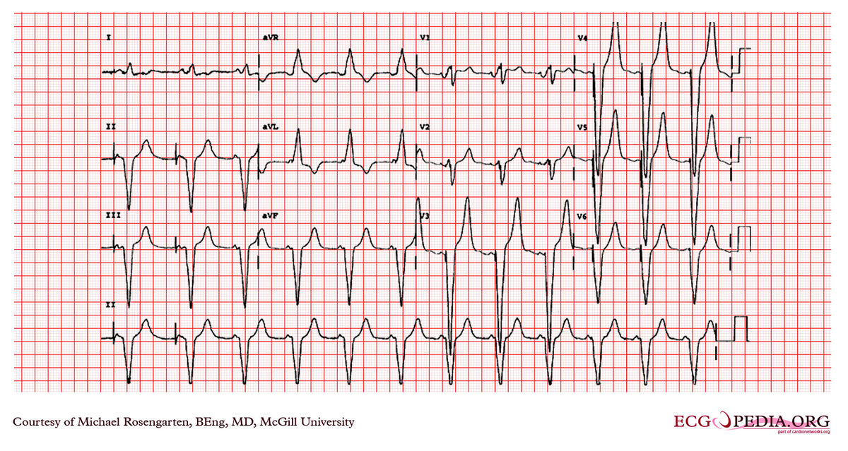 Mcgill Case 99 - Ecgpedia