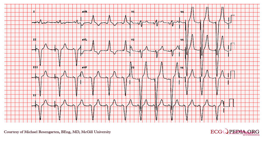 McGill Case 99 - ECGpedia