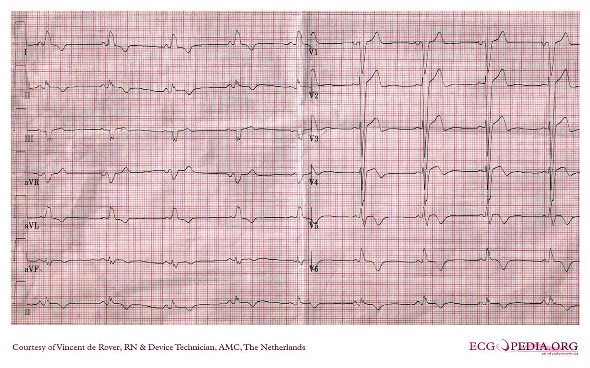 Amc Case 83 Ecgpedia