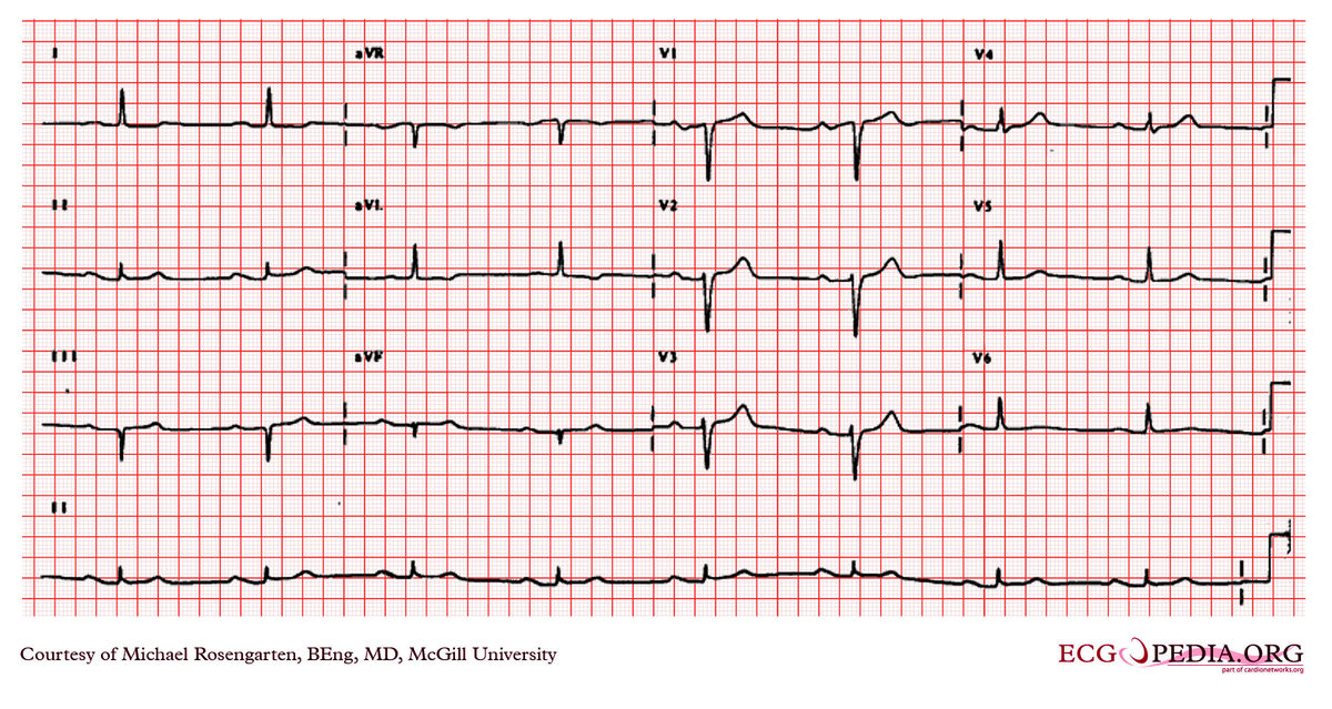 File:e000617.jpg - Ecgpedia