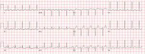 Sinustachycardia.jpg