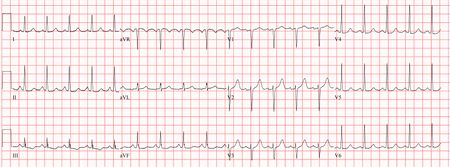 Sinus Tachycardia - ECGpedia