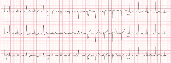 Sinus Tachycardia - ECGpedia