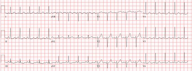 File:Sinustachycardia.jpg - ECGpedia