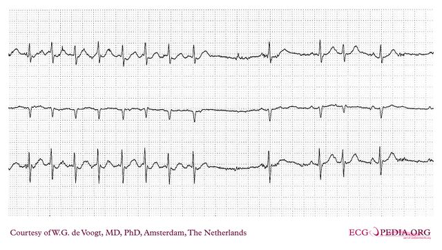 File:DVA0349.jpg - ECGpedia