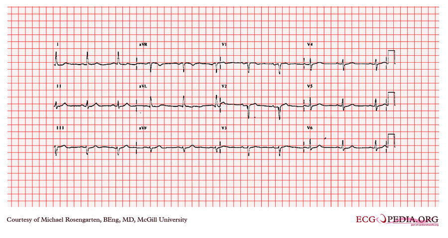 McGill Case 289 - ECGpedia