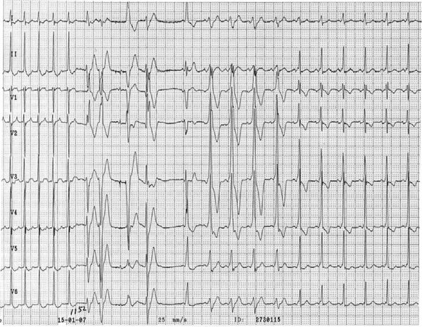 Puzzle 2007 5 198 Answer - ECGpedia