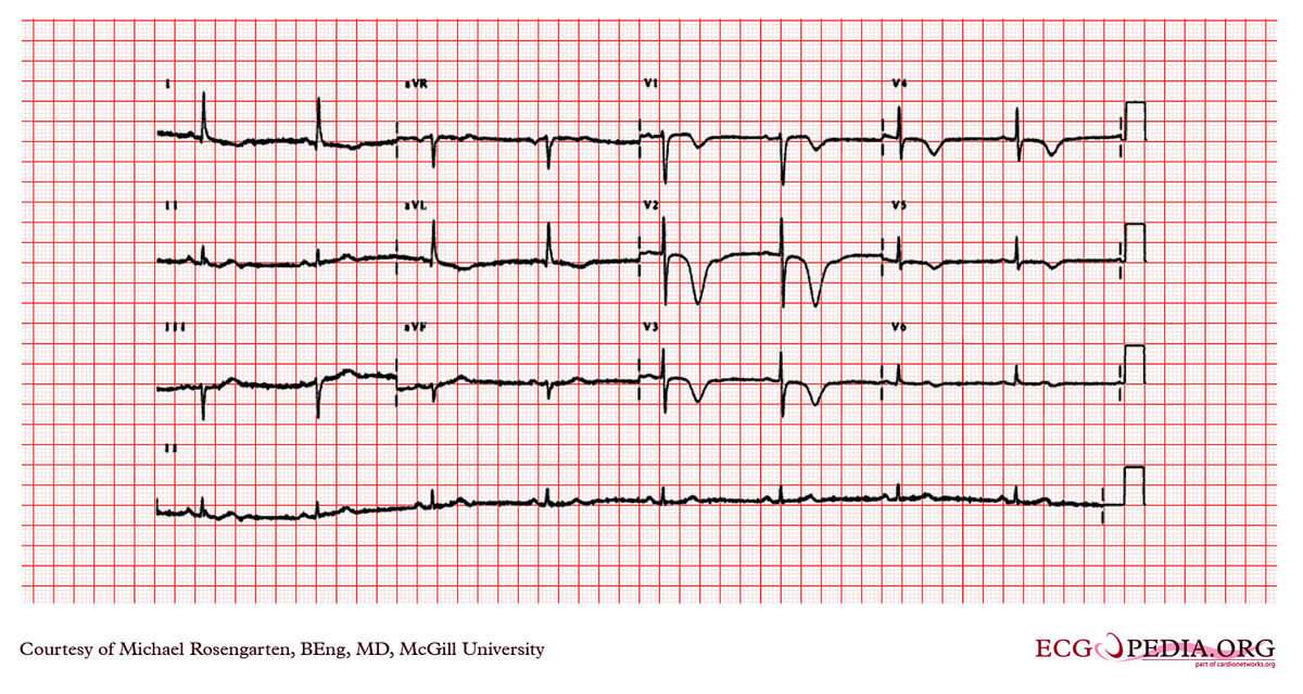 McGill Case 202 - ECGpedia