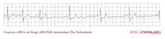 De Voogt ECG Archive - Ectopic Beats - ECGpedia