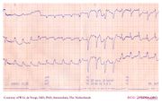 De Voogt ECG Archive - Intraventricular Conduction - ECGpedia