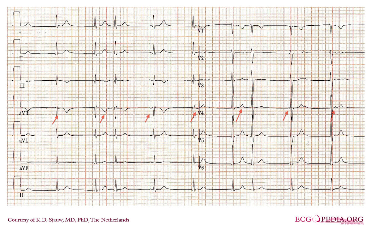 Answer - Case of the month (Feb 2012) - ECGpedia