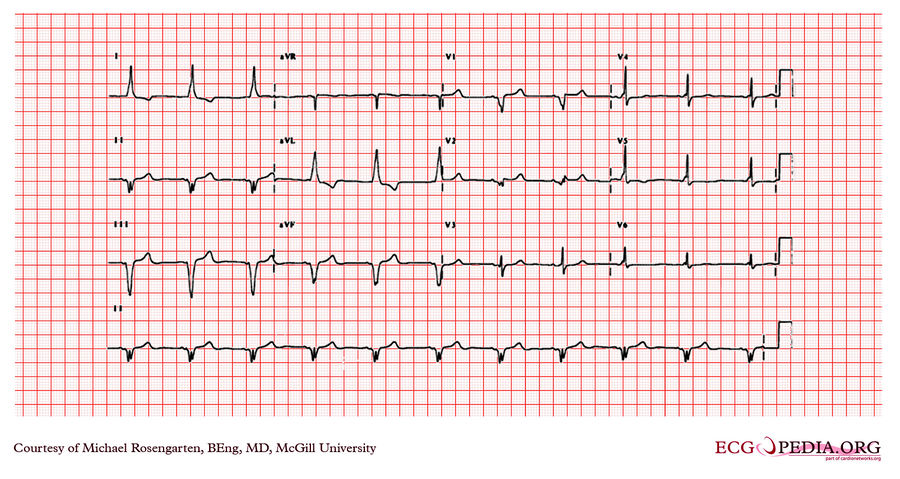 Mcgill Case 75 - Ecgpedia