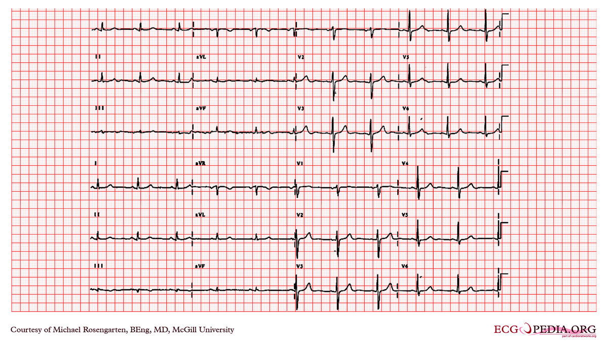 McGill Case 286 - ECGpedia