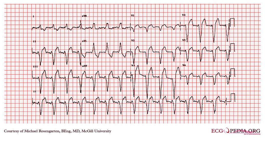 McGill Case 325 - ECGpedia