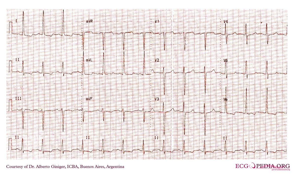 ICBA39 - ECGpedia