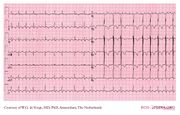 De Voogt ECG Archive - Supraventricular Rhythms - Atrial flutter - ECGpedia