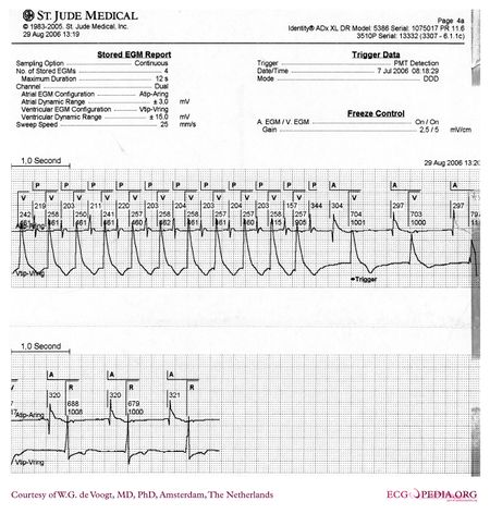 Pacemaker - ECGpedia