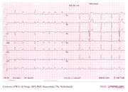 De Voogt ECG Archive - Intraventricular Conduction - ECGpedia